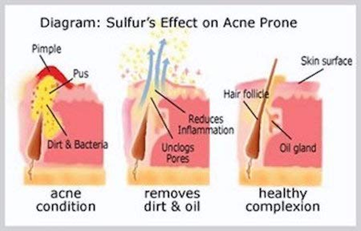 Sulfur Soap for Acne Pharmaceutical Grade Dermatologists Approved for Acne Rosacea 100G