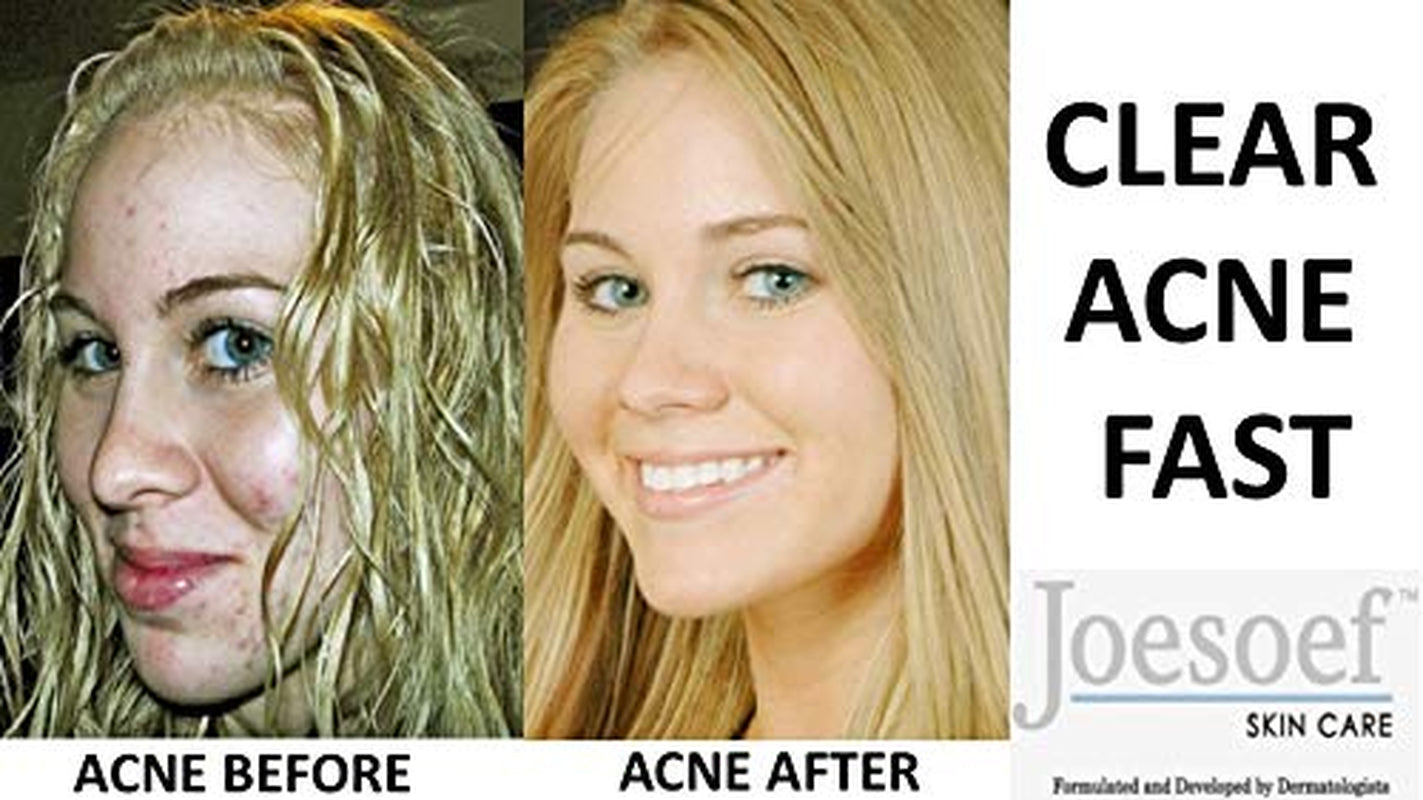 Sulfur Soap for Acne Pharmaceutical Grade Dermatologists Approved for Acne Rosacea 100G